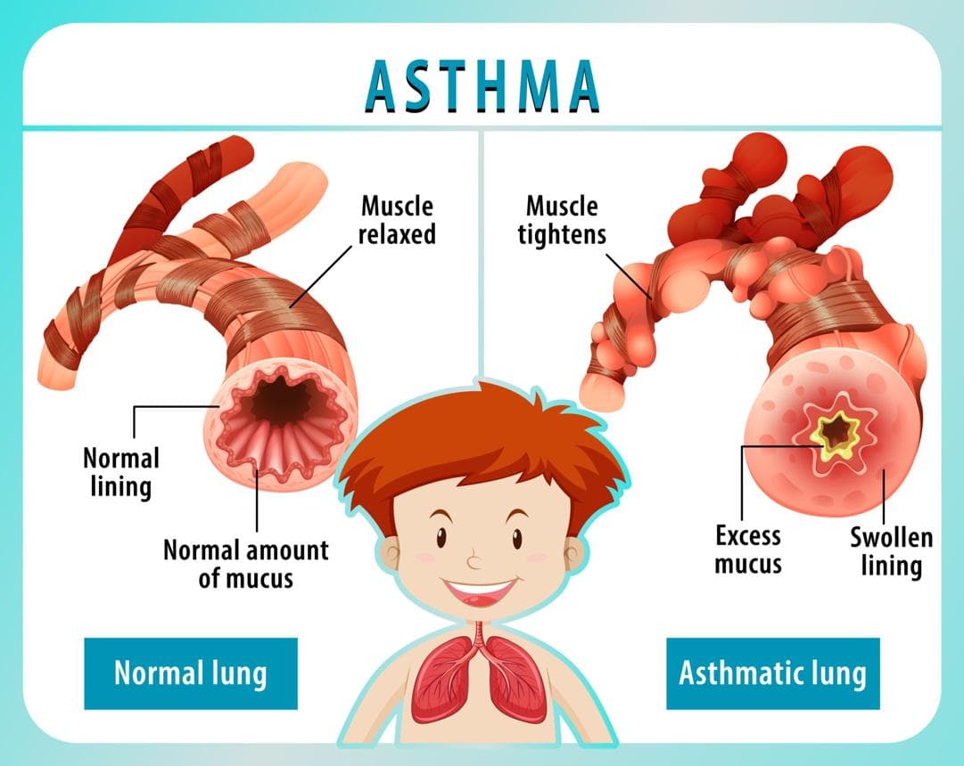 An image showing a normal lung in comparison to an asthmatic lung